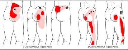 Glute Medius Minimus Referral Pattern