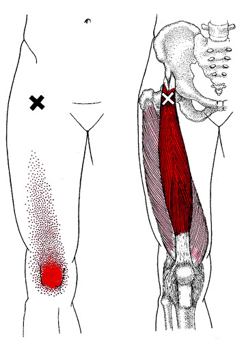 rectus femoris referral pattern