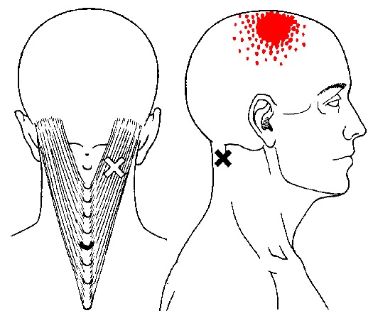 splenius capitis trigger points